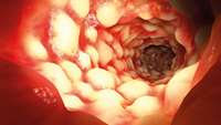 ستاد فرهنگسازی اقتصاد دانش بنیان Stem cell transplants to be used in treating Crohns disease