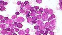 ستاد فرهنگسازی اقتصاد دانش بنیان New CD22 CAR-T cell therapy gives hope for acute lymphoblastic leukemia