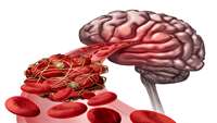 ستاد فرهنگسازی اقتصاد دانش بنیان Amniotic fluid may yield new, better treatment for ischemic stroke