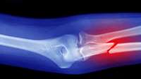 ستاد فرهنگسازی اقتصاد دانش بنیان After a bone injury, shape-shifting cells  attack to the rescue