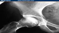 ستاد فرهنگسازی اقتصاد دانش بنیان Correlation between the efficacy of stem cell therapy for osteonecrosis of the femoral head and cell viability