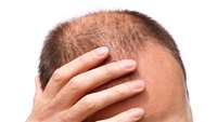 ستاد فرهنگسازی اقتصاد دانش بنیان Escape of hair follicle stem cells causes stem cell exhaustion during aging