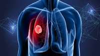 ستاد فرهنگسازی اقتصاد دانش بنیان  Metabolomics Crucial To Personalizing Lung Cancer Therapy