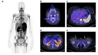 ستاد فرهنگسازی اقتصاد دانش بنیان Whole-body CD8  T cell visualization before and during cancer immunotherapy: a phase 1/2 trial