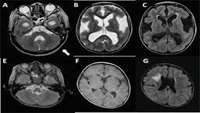 ستاد فرهنگسازی اقتصاد دانش بنیان Novel gene therapy offers potential treatment for FCMD