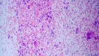 ستاد فرهنگسازی اقتصاد دانش بنیان Specific cancer driving protein plays important role in lung cancer development