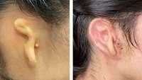 ستاد فرهنگسازی اقتصاد دانش بنیان Doctors Transplant Ear of Human Cells, Made by 3-D Printer