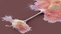 ستاد فرهنگسازی اقتصاد دانش بنیان  Reprogrammed Cells Attack and Tame Deadly Cancer in One Woman