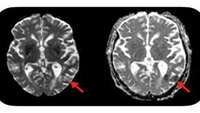 ستاد فرهنگسازی اقتصاد دانش بنیان  Simple blood test predicts neurotoxic complications of CAR-T cell therapy