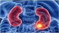 ستاد فرهنگسازی اقتصاد دانش بنیان CAR T-cell therapy shows promise in renal cell carcinoma