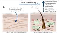 ستاد فرهنگسازی اقتصاد دانش بنیان Scars mended using transplanted hair follicles in Imperial College London study