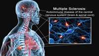 ستاد فرهنگسازی اقتصاد دانش بنیان Multiple Sclerosis (MS): Stem cell treatment may prevent worsening of symptoms