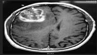 ستاد فرهنگسازی اقتصاد دانش بنیان Self-Assembling Chemoimmunotherapy Hydrogel Treats 100% of Glioblastoma-Bearing Mice