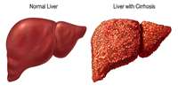 ستاد فرهنگسازی اقتصاد دانش بنیان Combo Cell Therapy Promotes Healing of Cirrhosis-Damaged Liver