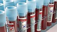 ستاد فرهنگسازی اقتصاد دانش بنیان Third person ‘cured of HIV’ after showing no signs of virus 4 months following stem cell transplant