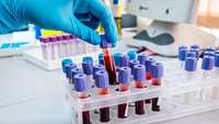 ستاد فرهنگسازی اقتصاد دانش بنیان The Holy Grail of cancer research is discovered: New blood test that can detect 10 different types of cancer YEARS before someone gets ill