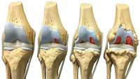 ستاد فرهنگسازی اقتصاد دانش بنیان    Clinical trial shows promise of stem cells in offering safe, effective relief from arthritic knees