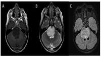 ستاد فرهنگسازی اقتصاد دانش بنیان Pediatric brainstem cancer eradicated in mice using CAR-T treatment