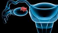 ستاد فرهنگسازی اقتصاد دانش بنیان Ovarian cancer: Scientists find a way to launch dual attack