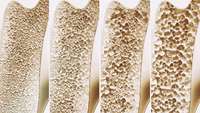 ستاد فرهنگسازی اقتصاد دانش بنیان Research implicates causative genes in osteoporosis, suggesting new targets for future therapy